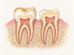 Cross-section of two teeth comparing external yellow stains on the enamel surface with internal yellowing from thin enamel exposing dentin underneath, surrounded by healthy pink gums.